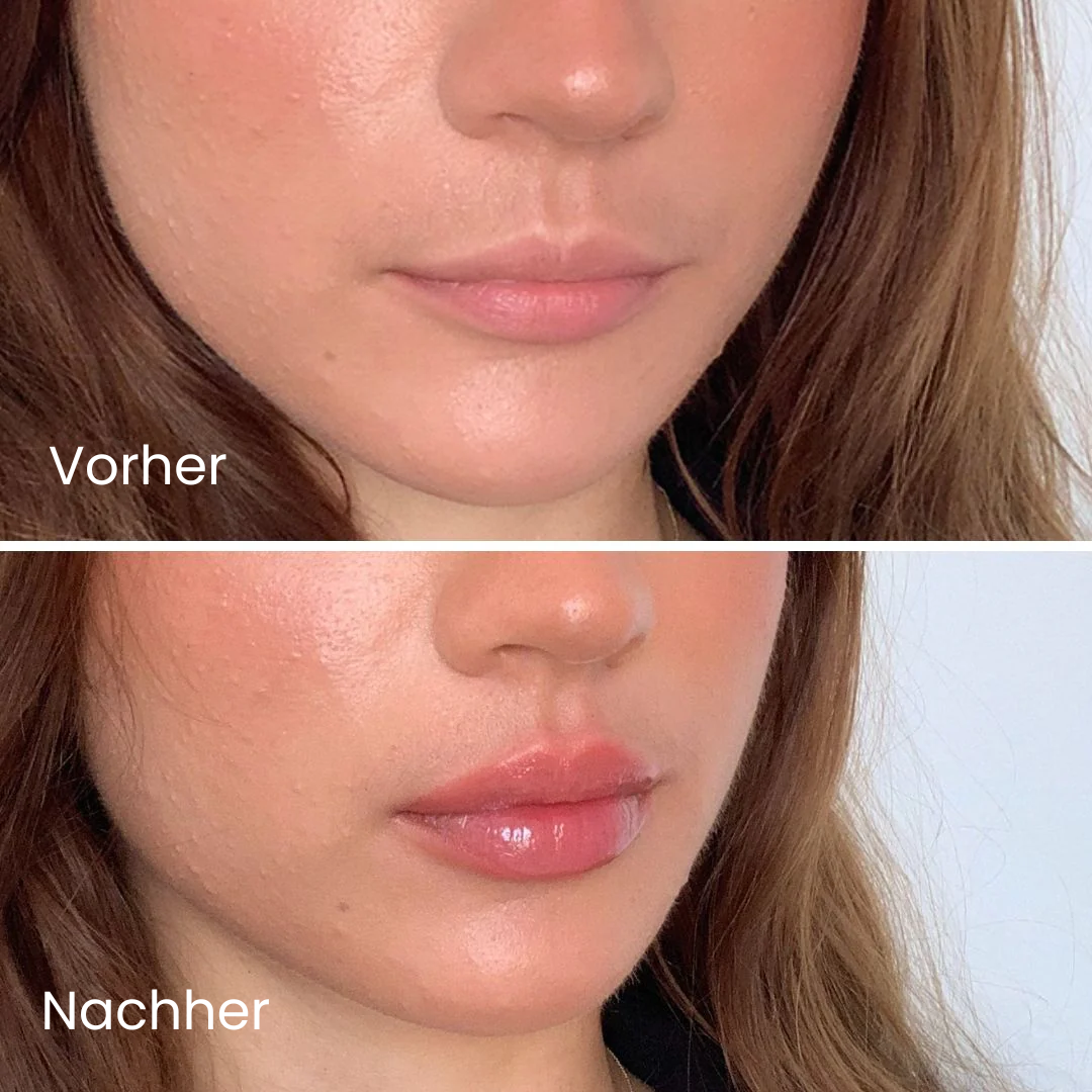 Normal & Extreme Lip Plumper